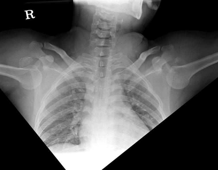 상완골대결절골절을동반한양측견관절하방탈구 491 Fig. 1. Radiograph shows inferior dislocations of both shoulders with the humeral head faced downward. The greater tuberosities on both sides were fractured. Fig. 3.