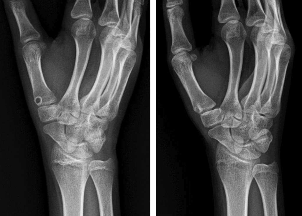 (A) Radiograph demonstrating reduced carpometacarpal joint of the thumb with a hole at the metacarpal base made to pass the split of flexor carpi radialis tendon.
