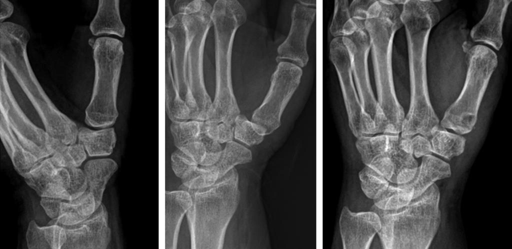 (B) Radiograph of the wrist at 1 month after injury showed radially displaced carpometacarpal joint of the thumb. (C) Follow-up radiograph at 12 months after the surgery showed congruent joint space.