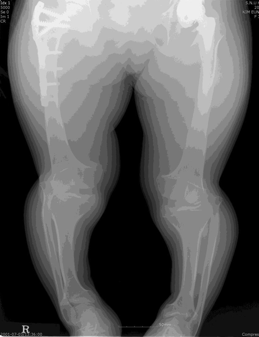 가성연골무형성증 척추-골단-골간단이형성증 짧은손, 발 사지변형,
