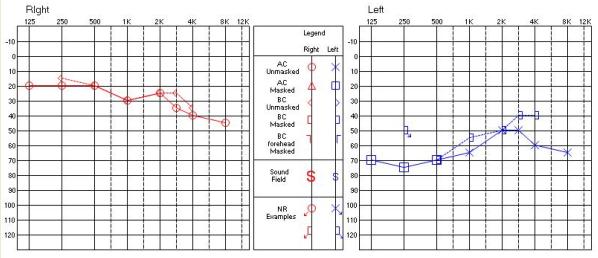 이미숙외사상체질의학회지 2011;23(2):419-428 421 Figure 1. Pure tone adiometry(2/17) Loss) 진단받고, 2011년 2월 17일부터2011년 2월 24일까지입원하여고용량스테로이드요법 (Methylprednisolone 4mg 12정을하루에한번경구복용 ) 을받았으나별다른호전없이퇴원하였다.