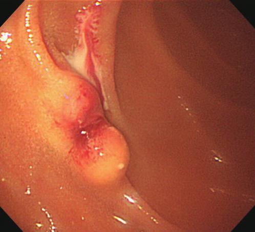 그림 7 림프관종 5) 위장관간질종양 (GIST, Gastrointestinal stromal tumor)