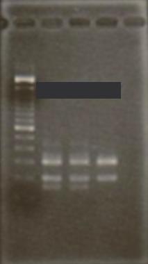 세포유전학검사는첫번째골수검사때와마찬가지로정상핵형을보였으며 BCR-ABL1 융합유전자는음성이었다. 증폭불응성돌연변이시스템중합효소연쇄반응 (amplification refractory mutation system PCR, ARMS-PCR) 을이용하여 JAK2V617F 유전자돌연변이를검출하고유전자염기서열분석을통하여이를확인하였다 (Fig. 2).