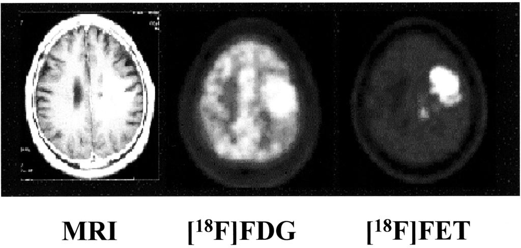 MRI FDG - PET, FET - PET.