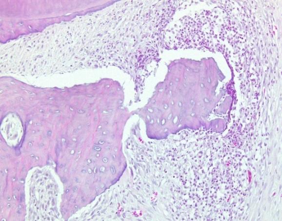 Inflammatory cells (neutrophils) surround necrotic alveolar bone with empty lacunae (Z group,