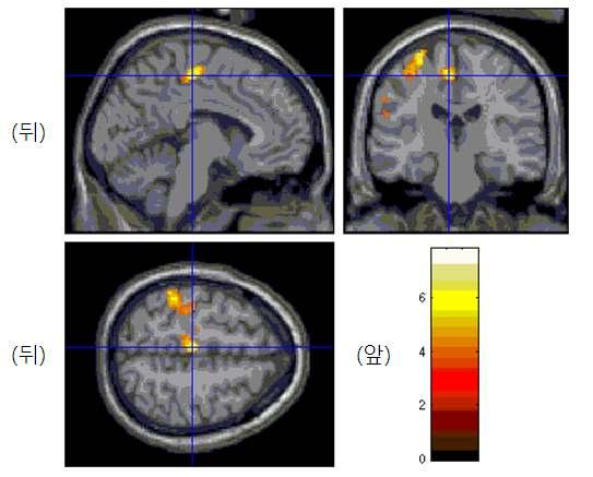 염전자극과위침자극비교(S2-Sham) 에의한뇌의활성영역 Anatomical area Brodmann Area Talrairach Coordinate T-value k x y z Lt. Superior Temporal Gyrus 39-57 -61 25 8.44 111 6.