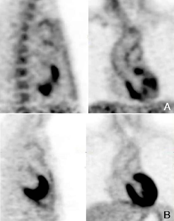 Se Woo Park, et al. : The Role of Positron-Emission Tomography in Takayasu Arteritis 개월간복용한후중단하였다. 그러나이때혈압이 50/80 mmhg로다시상승하여 ACE inhibitor 를추가처방하였다.