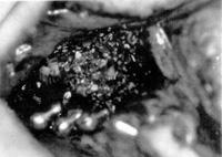 [ 사진 5] 7) Composite graft of Cavity 전체 case중지연매식한 A를제외하고 B,C,D,E 네명의환자는매식체를위치시킨후에충전재를채웠으며 F의경우는 drilling후충전재를채우고나서매식체를 tapping해서넣었다 (4. 17).