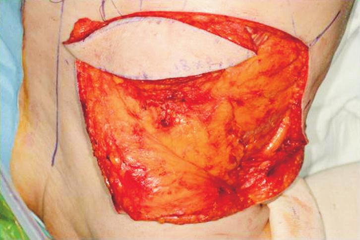 (D) Imme diate post-operative view; after advancement of intercostal artery perforator flap and trans position of