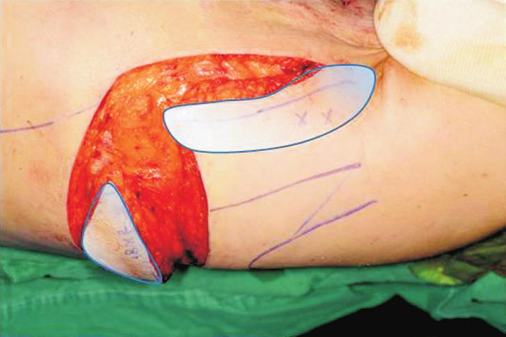Immediate post-operative view; 1: advanced intercostal artery perforator flap, 2: transposed  방사선 유발 만성 흉부 궤양에서는, 궤양의 깊이와 정도