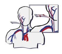 Arterio-Venous CRRT 또는 Veno-Venous CRRT? arterio-venous( 동정맥 ) - puncture of A. femoralis necessary(complications!