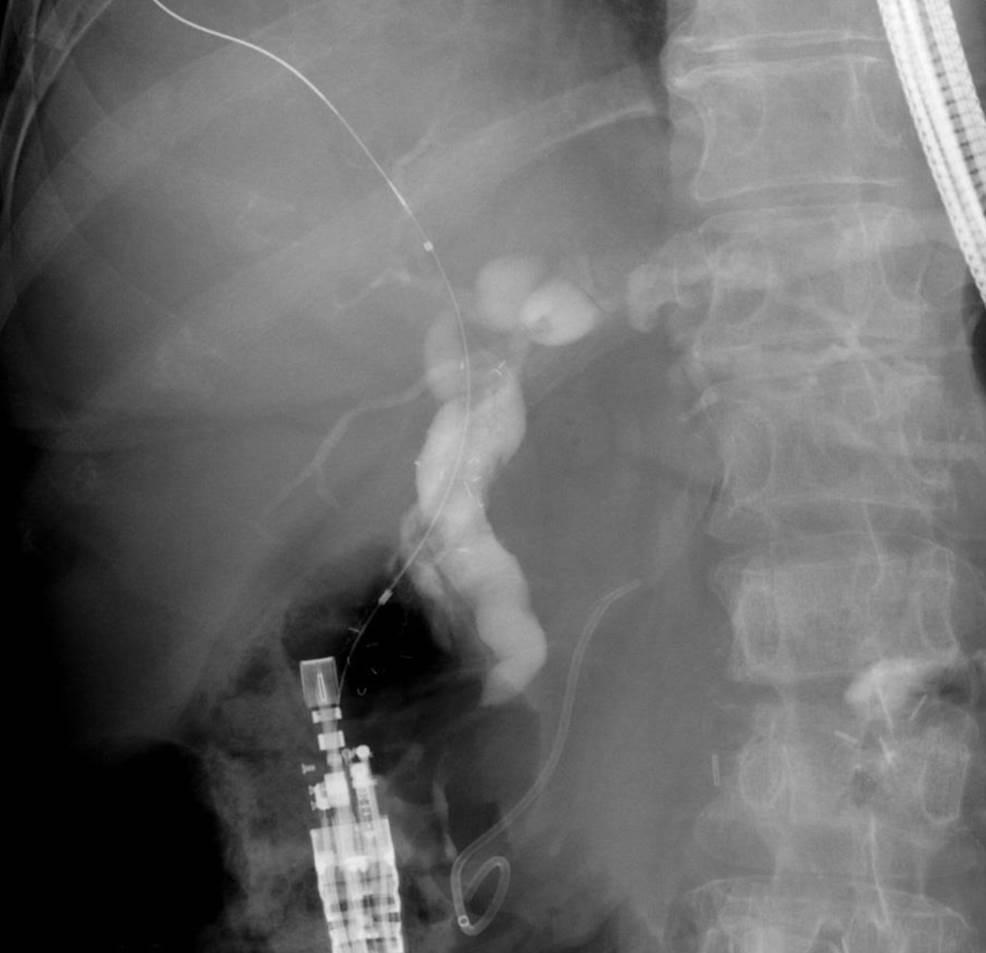 (C) A guidewire was inserted and a metal stent placed from the duodenum into the CBD.