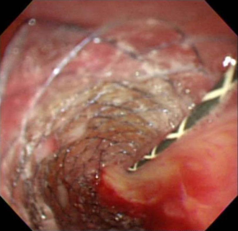 EUS-guided gallbladder drainage to treat gangrenous cholecystitis due to pancreatic cancer.