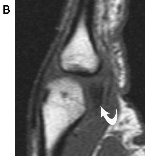 MRI 영상에서는수장판의손상유무 및정확한범위와전위정도를확인할수있다. 또한 곁인대는탈구및부가적으로생기는외측전위로인해 서손상될수있고이역시 다 (Fig. 11).