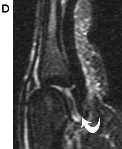 swelling in volar plate (curved arrows)in 2nd MCP joint with volar subluxation of the joint on MRI.