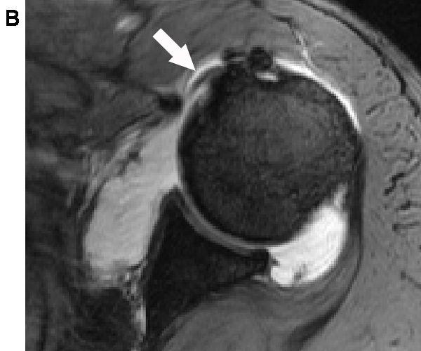 2) 수있으며 초음파에서도동일한소견을축상영상에서확인할 MRI에서는확인하기어려운일과성탈구도 역동적검사를통해진단할수있다. 8) A C Fig. 3. A sixty-five year old male patient has suffered from pain in left shoulder after slip down, 3 or 4 years ago.