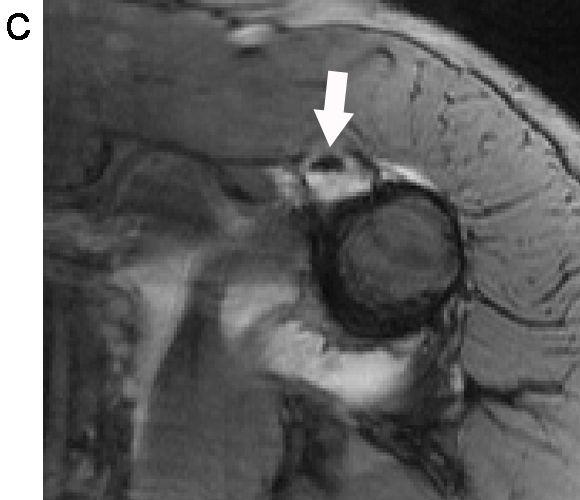 On arthroscopic examination, there was instability in biceps-labral complex and more than 50% tear in biceps brachii long head tendon with medial dislocation.