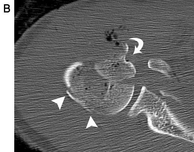 Images from J Shoulder Elbow Surg by K. Tamai. D A B Fig. 5.