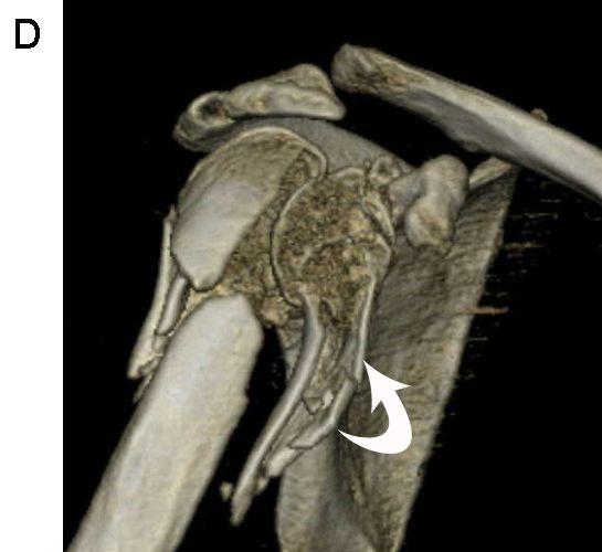 On axial reformatted(b) and 3D volume rendering (C and D) shoulder CT, there islongitudinal split fracture in