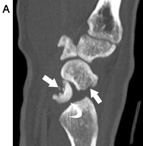 146 Journal of Soonchunhyang Medical Science Vol.16 No.1 June 2010 손배뼈경유반달뼈주위탈구 A C (Trans-scaphoid perilunate dislocation) 손을과신전시키고쭉뻗은상태에서낙상할경우에 발생하는손상이다. 비교적드물게생기는편이나손목 의손상중에는가장흔히발생하는형태이기도하다.