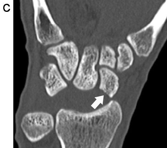 Other carpal bones show slight posterior subluxation to radiocarpal joint with fracture in capitate (asterisk). 단순촬영은손목뼈의탈구및기타손상이의심될때 가장먼저시행되는검사이다. 전후면에서는정상적인 손목뼈의궁이소실되어보이고측면상에서는위에언 급한것과같은소견을보인다.
