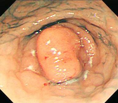 - 강선형외 1 인. 위선종의치료전략 - A B C D Figure 2. A case of metachronus cancer. 64-year-old female patient presented with gastric mass.