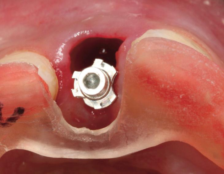 Intraoral photographs of immediate implant