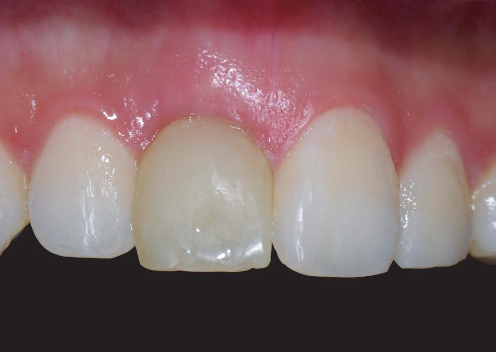 Intraoral photograph after provisional prosthesis delivery.
