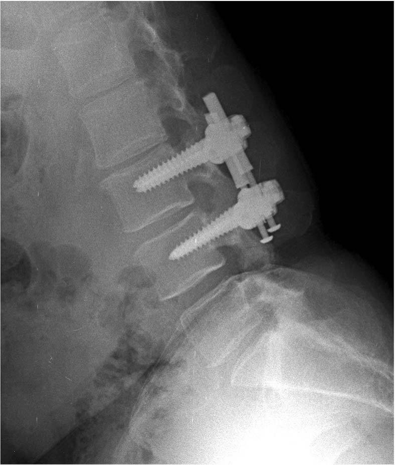 NFlex dynamic stabilization