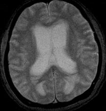 5점으로의식저하소견을보여시행한뇌확산자기공명영상 (diffusion MRI) 에서뇌수두증소견이관찰되었고 (Figure 2), FIGURE
