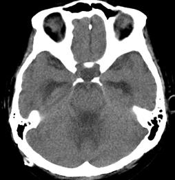 ventricle. Hydrocephalus improvement was maintained after operation. A FIGURE 5.