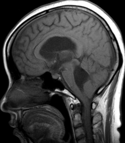 내원후시행한뇌전산화단층촬영 (computed tomography: CT) 소견상이전입원및경과관찰 상관찰되지않았던최대직경 33 mm 의제 4뇌실확장소견이관찰되었다