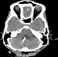 중앙에서우측으로 3 cm, 뒤통수점 (inion) 에서하방 2 cm 위치가뒤통수정맥동 (occipital