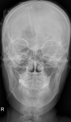 Skull simple X-ray after 2 nd shunt operation.