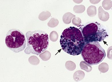 FAB classification M4EO Bone marrow smear from a patient with acute myelomonocytic leukemia with increased marrow eosinophils (FAB classification M4EO) and an
