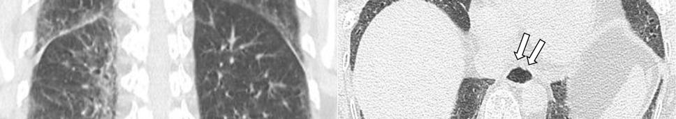 lower lungs. (B) Luminal dilatation of the distal esophagus (arrows). 손가락과오른쪽세번째, 네번째손가락을검사하였고, 평균 1 mm당모세혈관 3-4개로심한무혈관지역을보이며확장된모세혈관고리와거대혈관이보이는후기전신경화증패턴에합당하였다.