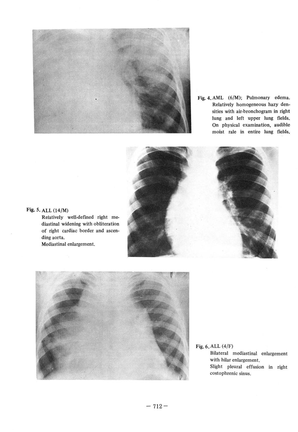 Fig. 4. AML (6/M); Pulmonary edema. Relatively homogeneous hazy densities with air-bronchogram in right lung and left upper lung fields.