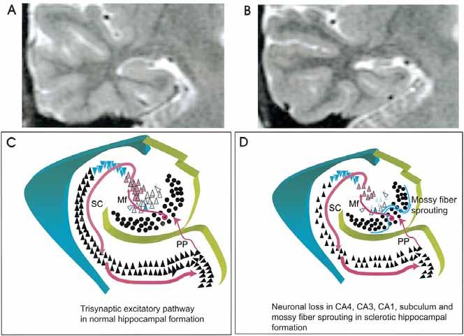 서대원 Figure 4. Brain MRI and schematic drawing of hippocampal formation. (A) T2 weighted image of a normal subject shows normal hippocampal structure, which looks like a sea-horse shape.