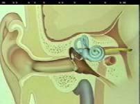 Implant) 심뇌자극기 (Deep Brain Stimulator) 인공망막 (artificial retina)