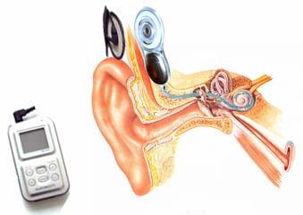 인공와우를통한음성인식과정 청각역치수준 95dB 이상의고도난청자의청각기능을회복시키기위한신경보철장치 (Neural