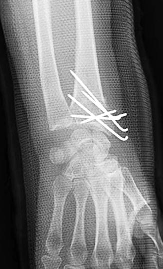 (D) On last follow-up after removal of K-wires, radiographs show changes in the radiologic indices that reflect reduction loss (radial
