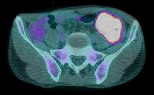 (A) Abdominalpelvic CT shows mass-like lesion, distal descending and