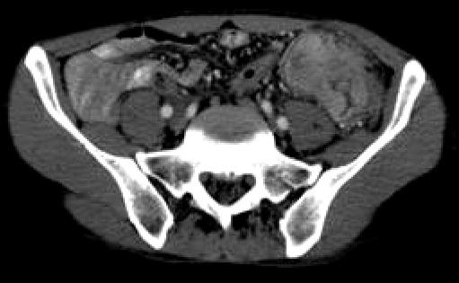 invasion. (B) PET-CT shows no distant metastasis. Figure 3.