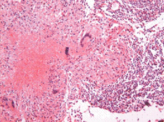 Figure 4. Microscopic findings. (A) There are typical caseating granulomas and severe active inflammation of the serosa of the operated specimen (H&E stain, 40).
