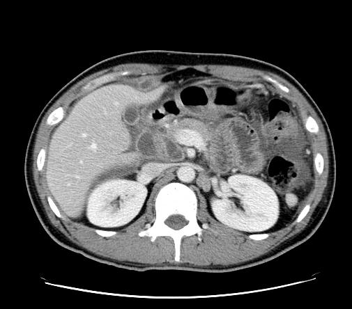 - Hoon Yu, et al. T mycotic aneursym rupture - 내원하였다. 환자는내원 7개월전복통과열을주소로타병원에내원하여대장내시경, 복부전산화단층촬영을시행하였으며결핵성복막염이의심되는소견으로복강경을이용한조직검사시행하여결핵성복막염으로진단받았다.