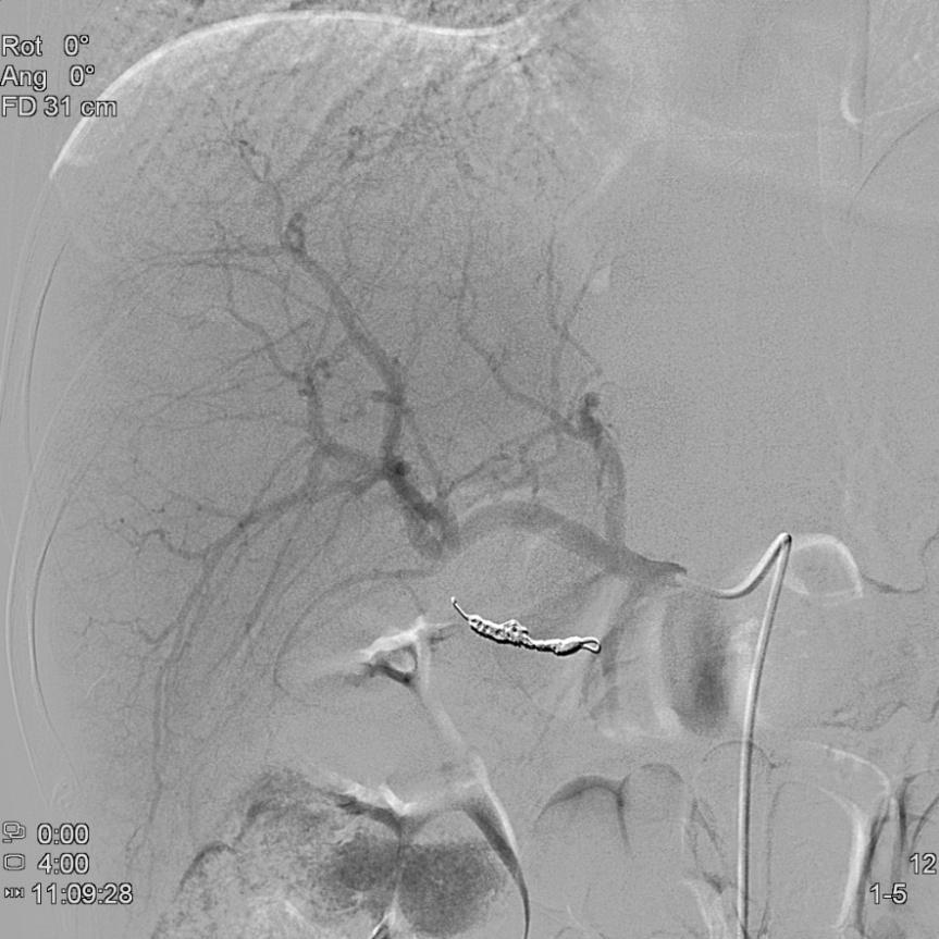 Surrounding mucosa shows hemorrhagic changes with some polypoid areas (arrow).