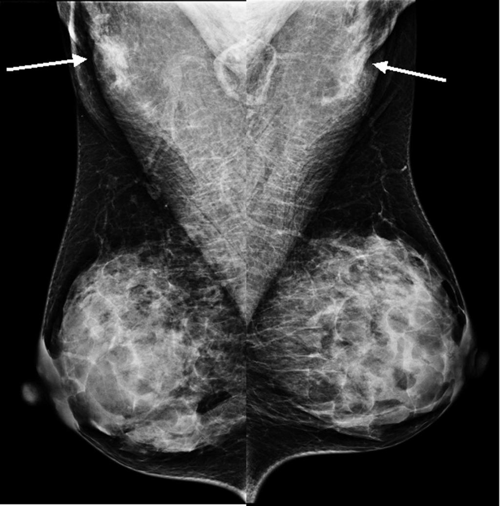 초음 파에서 정상 림프절은 중심부 지방문이 고에코로 주변부 얇은 피질이 저에코로 보인다 (Fig. 3). 병적인 림프절은 좀더 둥근 형태로 되어 높이와 폭의 비율이 1.5 이하이고 크기가 커지며 (2 cm 이상) 유방촬영술에서는 밀도가 정상 림프절보다 증가 Fig.