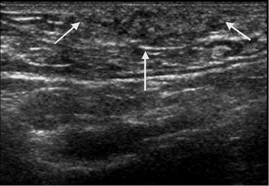 . ilateral mediolateral oblique mammograms show symmetric glandular tissues (arrows) in both axilla without any discrete masses.