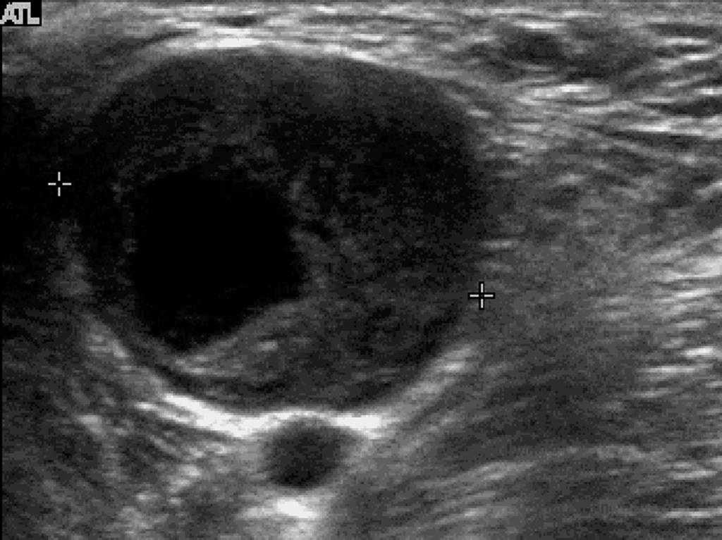 7. 42-year-old woman with tuberculous lymphadenitis and abscess formation due to spontaneous rupture.