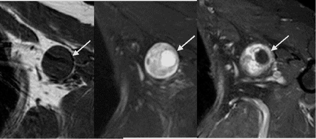 65-year-old woman with schwannoma in the right axilla. Sonogram shows an oval shaped circumscribed mostly hypoechoic mass (arrows).
